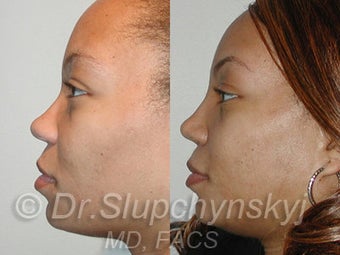 African American Rhinoplasty after 525580