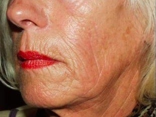 Sculptra Treatment after 370550