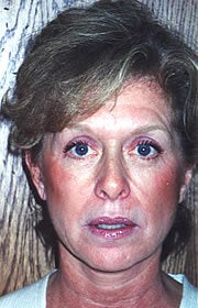 Face-neck Lift, SMAS elevation, LiveFill, Cheek Lift, and Upper Blepharoplasty after 83383
