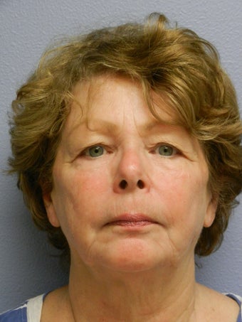Lower Face with Neck Lift before 598901