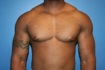 VASER Liposuction for gynecomastia before 507985