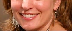 Botox for a gummy smile after 371663