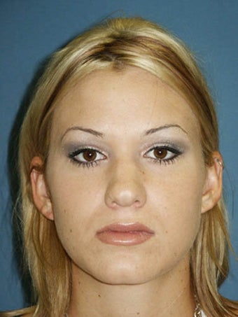 Rhinoplasty with sculpting of nasal tip and nasal dorsum before 249023
