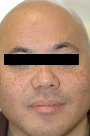 Asian Skin Freckle Removal before 199403
