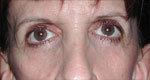 Infraorbital rim implants before 640072