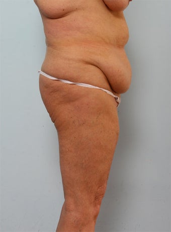 Body Lift before 260127