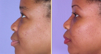 Nose Reshaping before 271207