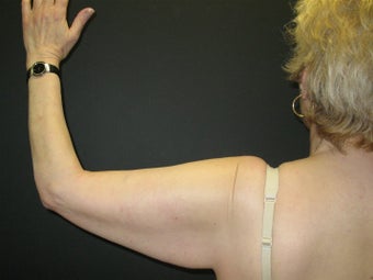 Arm Lift before 106148