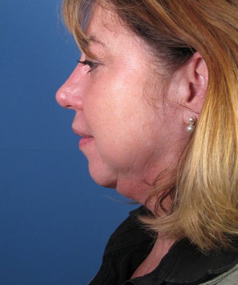 Chin Implant before 550579