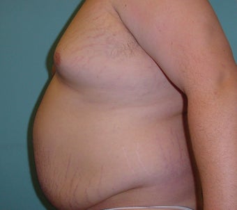 Male liposuction/liposculpture 314976