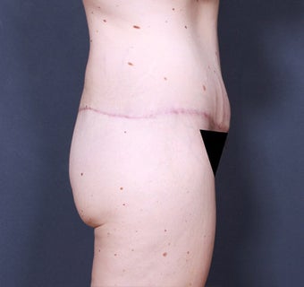 Body Lift 341226