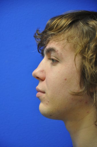 Rhinoplasty (correction of nasal vestibular stenosis/septoplasty) 533839