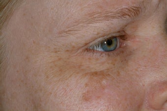 Non-surgical eye rejuvenation before 95918
