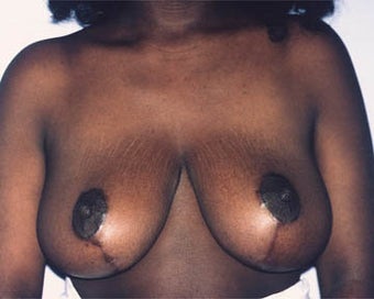 Breast Lift after 285340