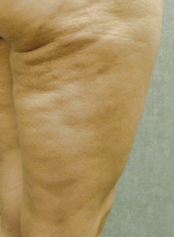 Cellulaze before 582615