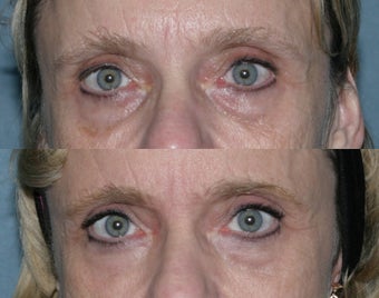 Fraxel repair with C02/Erbium lasers for upper lip wrinkles before 104307