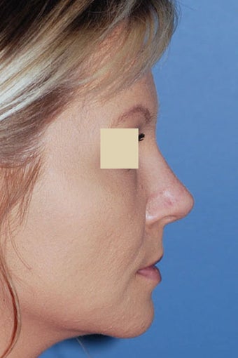 Revision Rhinoplasty after 88144