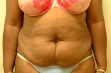 Abdominoplasty before 87345