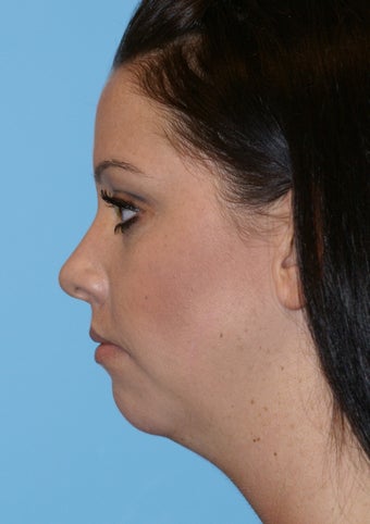 Chin Implant before 581194