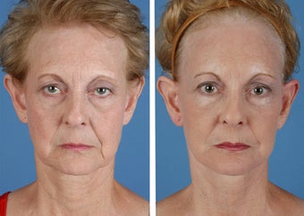 Facelift, Browlift, Upper and Lower Eyelid Surgery before 253952