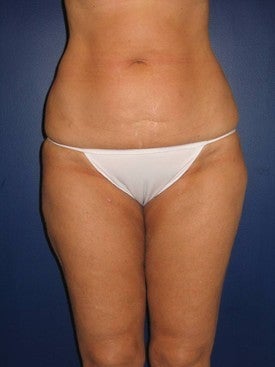 Liposuction of abdomen, hips, knees, and inner and outer thighs after 592900