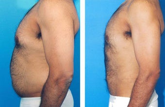 Liposuction before 636171