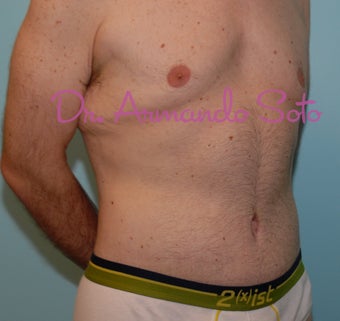 Lower Body Lift after 207537