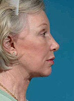 Facelift, eyelid surgery, neck & brow lift 458802