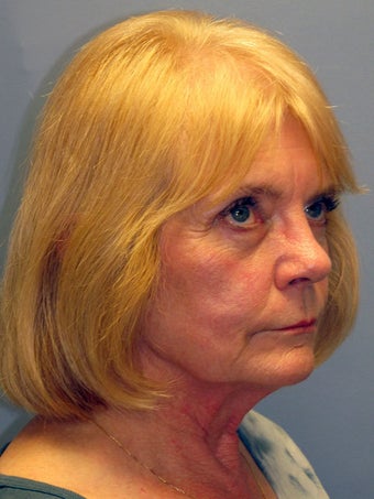 Neck Lift, Platysmaplasty before 634746
