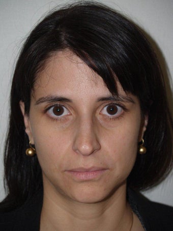Rhinoplasty before 309561