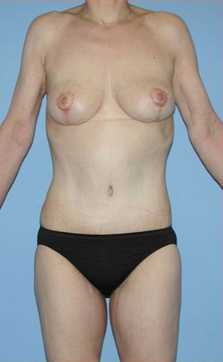 Complete Weight-Loss Makever (Body Lift, Breast Lift, Arm & Thigh Lift) after 533993