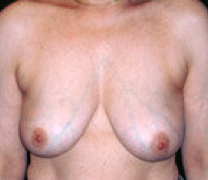 Breast implant removal after 316569
