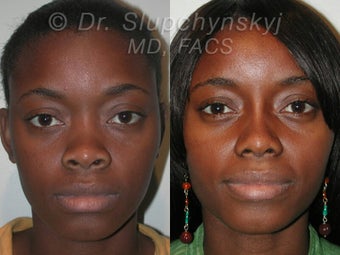African American Rhinoplasty 565837