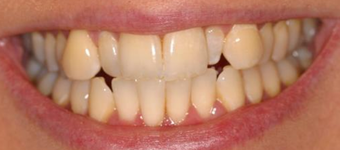 Invisalign, whitening, bonding before 119940