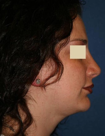 Liposuction face after 138117