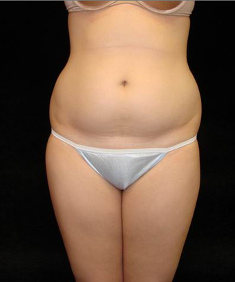 Liposuction before 159256