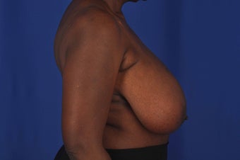 62 year-old woman desired bilateral breast reduction 647695