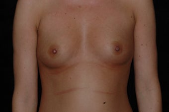 Breast Augmentation before 336398