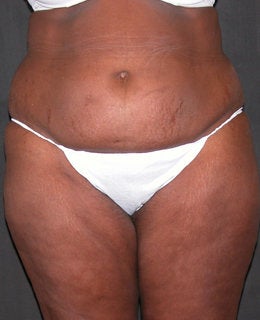 Tummy Tuck with Flank Liposuction before 330898