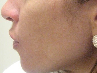 Isolaz treatment before 272102