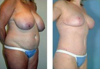 Mommy Makeover after 325029