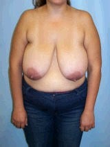 Breast Reduction Surgery before 146631