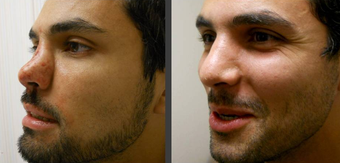 Rhinoplasty before 407965