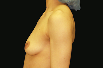 Breast Augmentation with mastoplexy before 630035