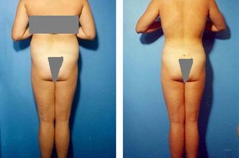 Liposuction before 636168
