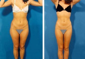 Liposuction before 636230