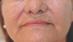 Perlane and Botox for mouth lines before 91299