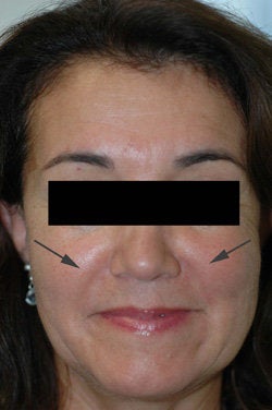 Restylane for laugh lines after 91298
