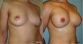 Breast reconstruction following bilateral mastectomy after 416794