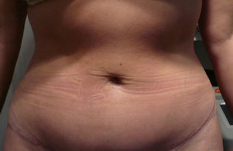 Smartlipo / liposuction before 166270